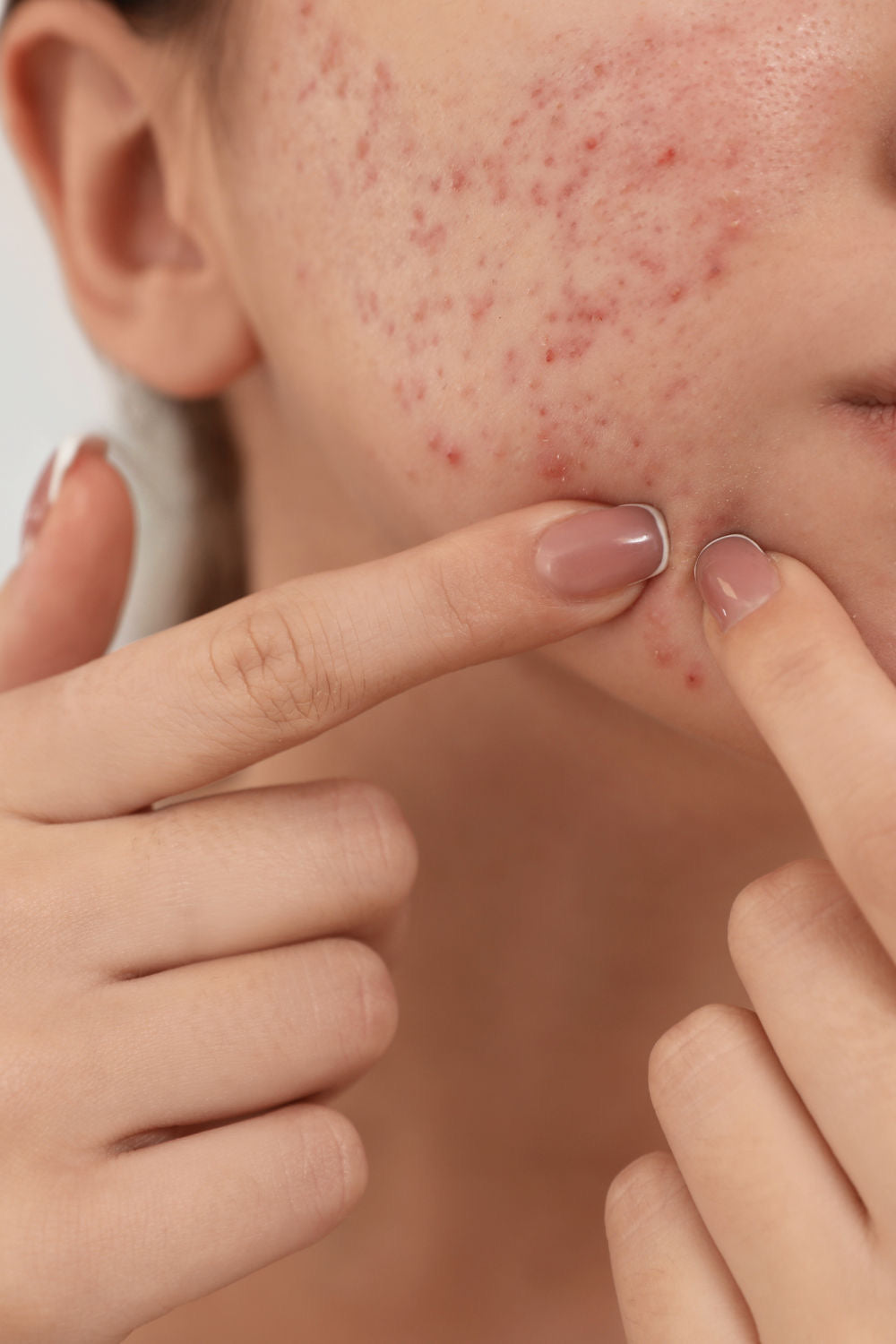 Acne Explained: Causes, Treatments & Skincare for Clearer Skin